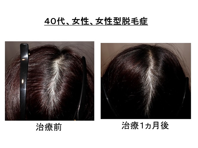 円形脱毛症　病院